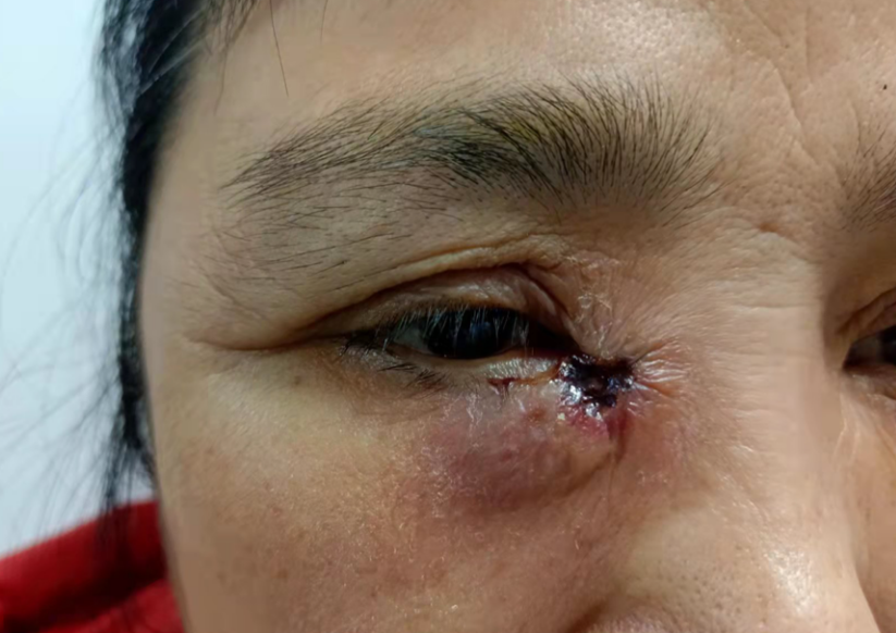 50岁阿姨眼睛肿成"馒头",急性泪囊炎原来这么可怕?