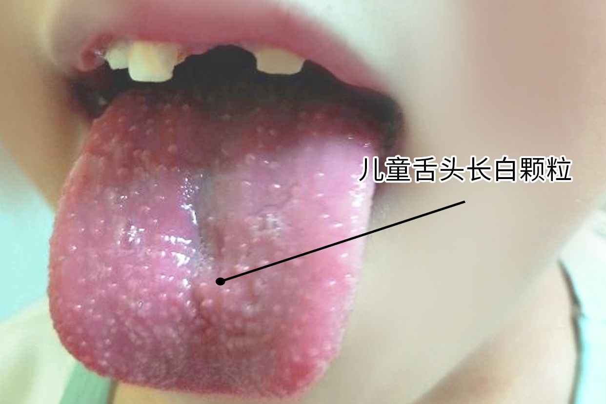 儿童舌头长白颗粒图片