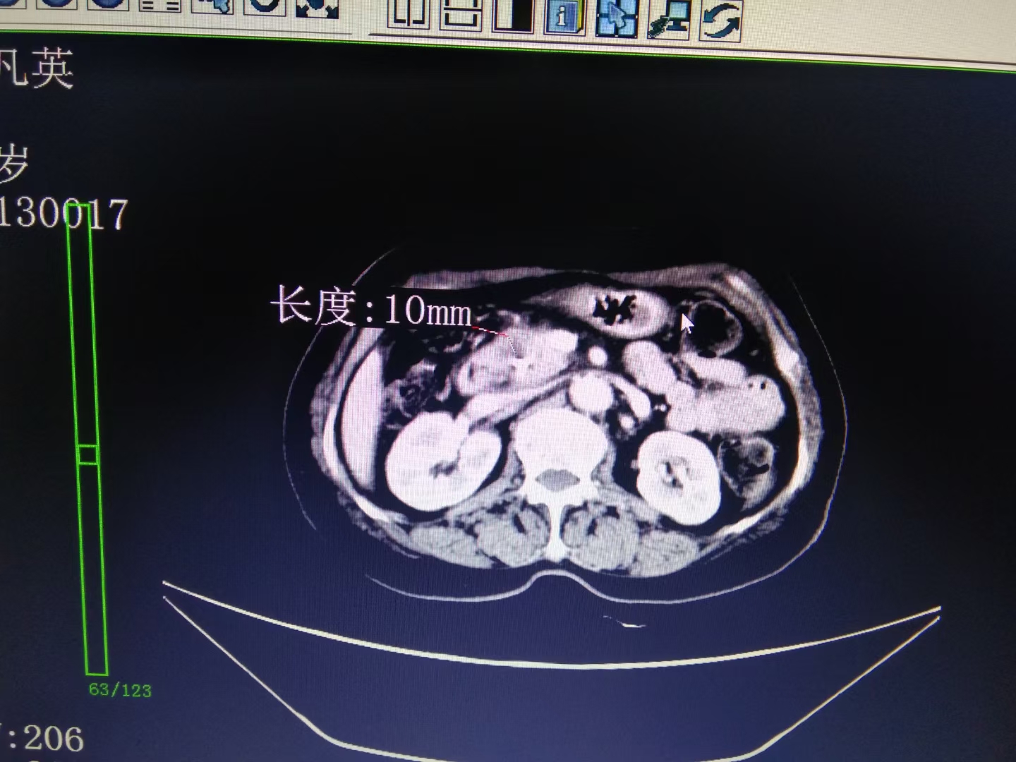 「病例分享」70岁娭毑胰头结节致胆道梗阻,穿刺活检确诊为胰腺癌