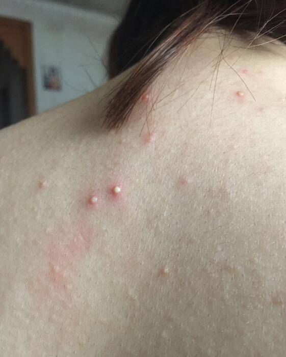 怎样快速除螨虫呢,下面教大家几个实用小妙招