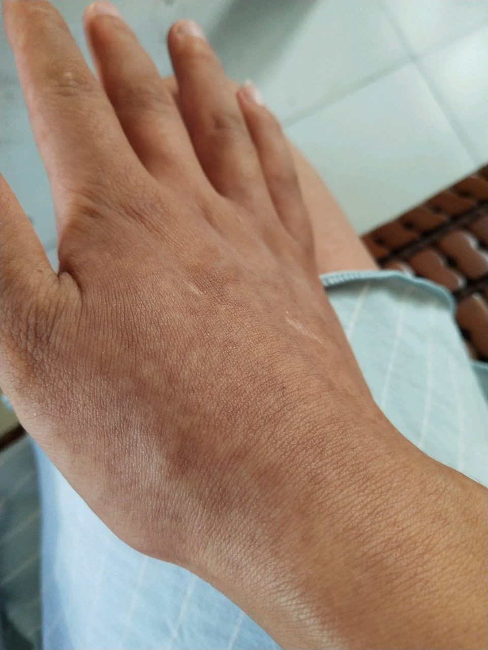 手上晒斑怎么去除掉 #医美科普挑战赛#   当我们经历了一个美好的夏天