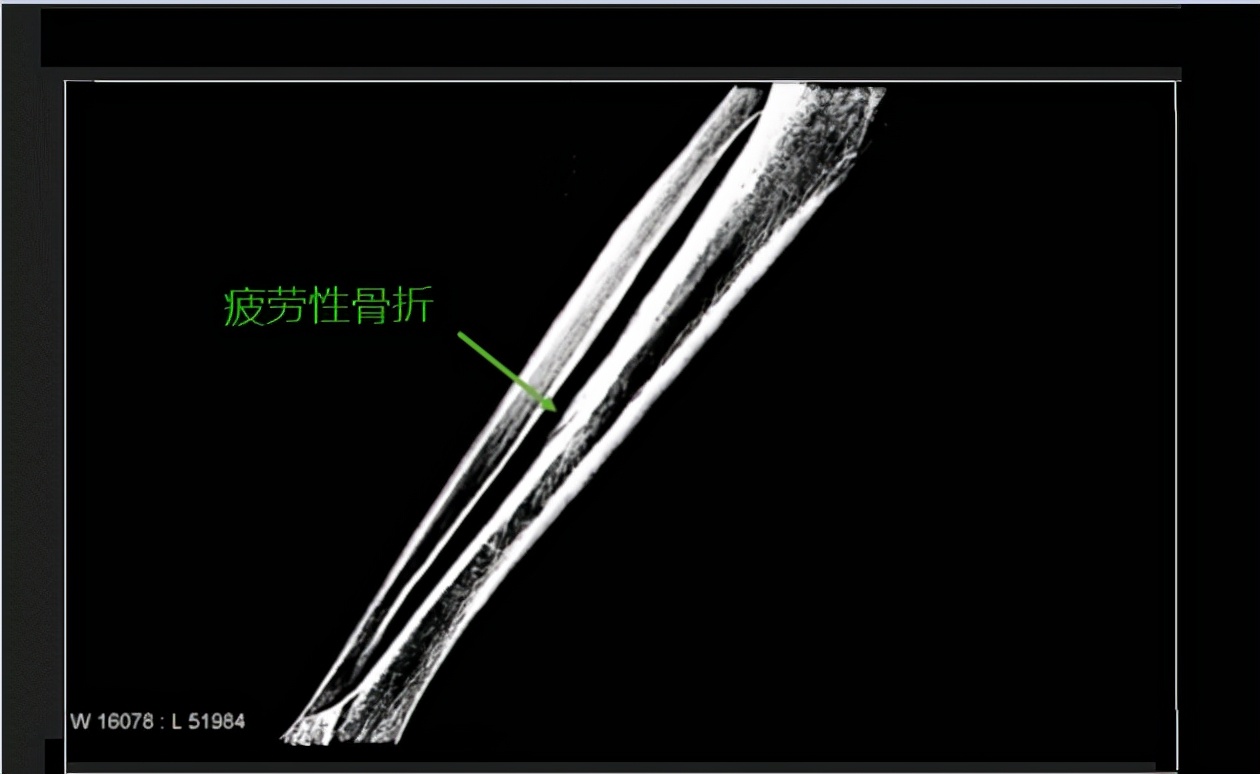 運動後腿疼,兩週後才發現骨折?這2類人最易疲勞性骨折,需注意