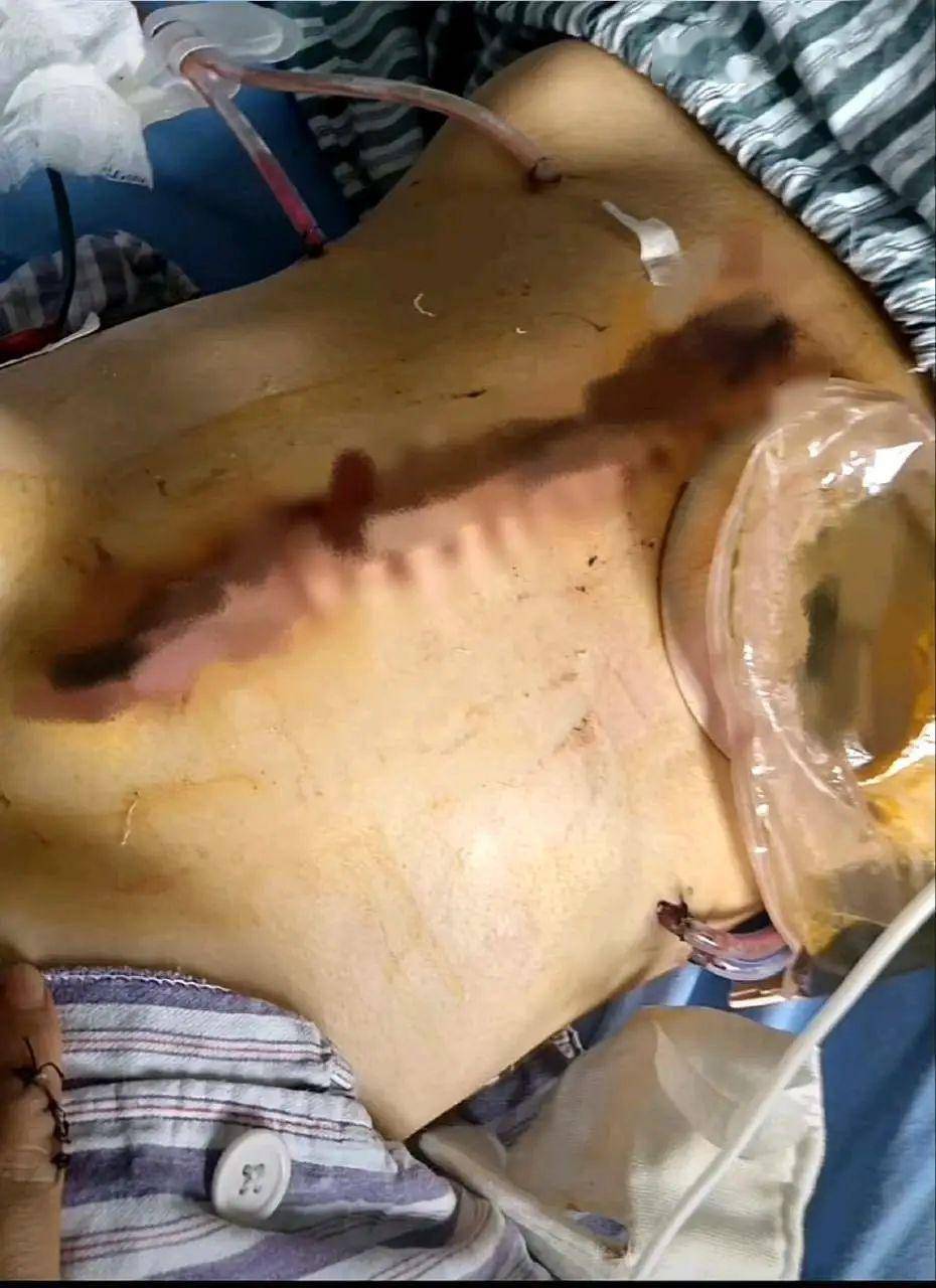 结婚2年被家暴16次,重伤终身挂粪袋!家暴男竟是两家公司老总!