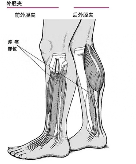 胫骨骨膜炎位置图片