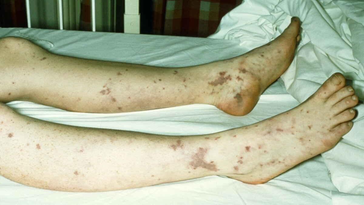 血液病医生史淑荣:一文get(了解)过敏性紫癜