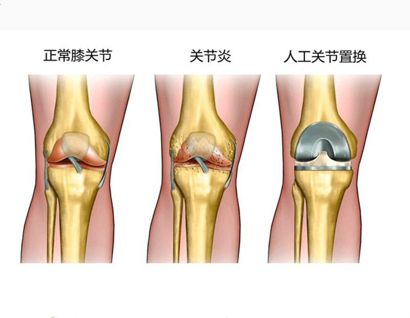 膝关节置换示意图图片