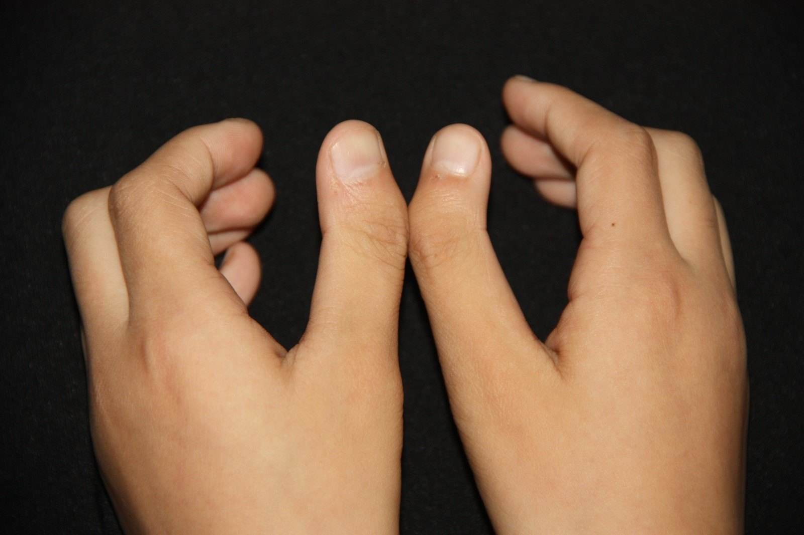 先天性并指多指畸形,多发于单侧手指,拇指和小指常见