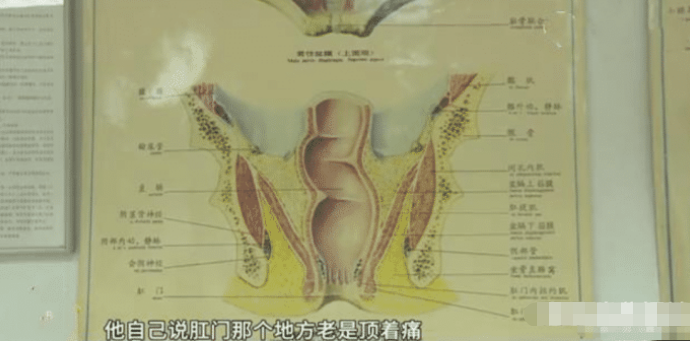男子屁股疼痛难忍,以为痔疮犯了,医生:肛门有鱼骨头