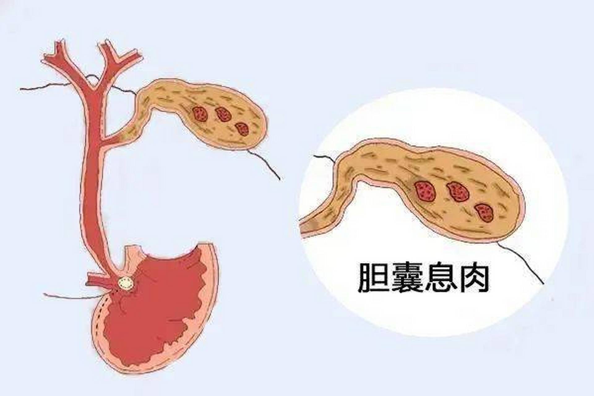 胆囊息肉能自愈吗图片