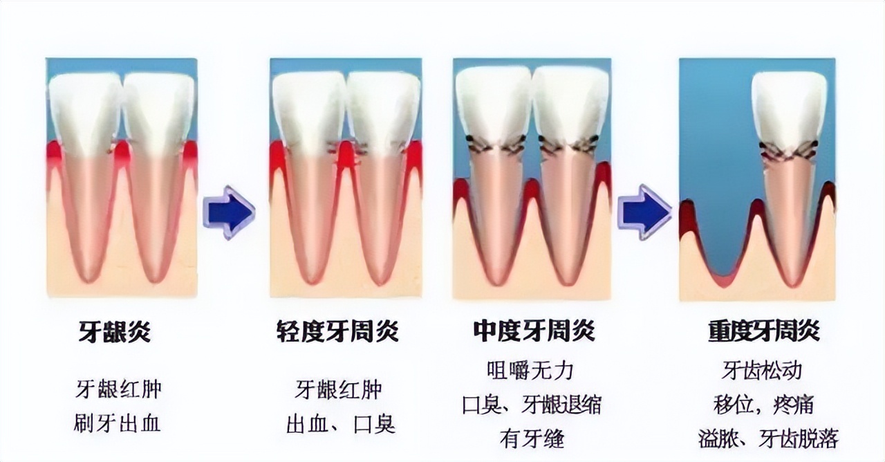 牙龈萎缩是什么原因?牙龈萎缩怎么防治?