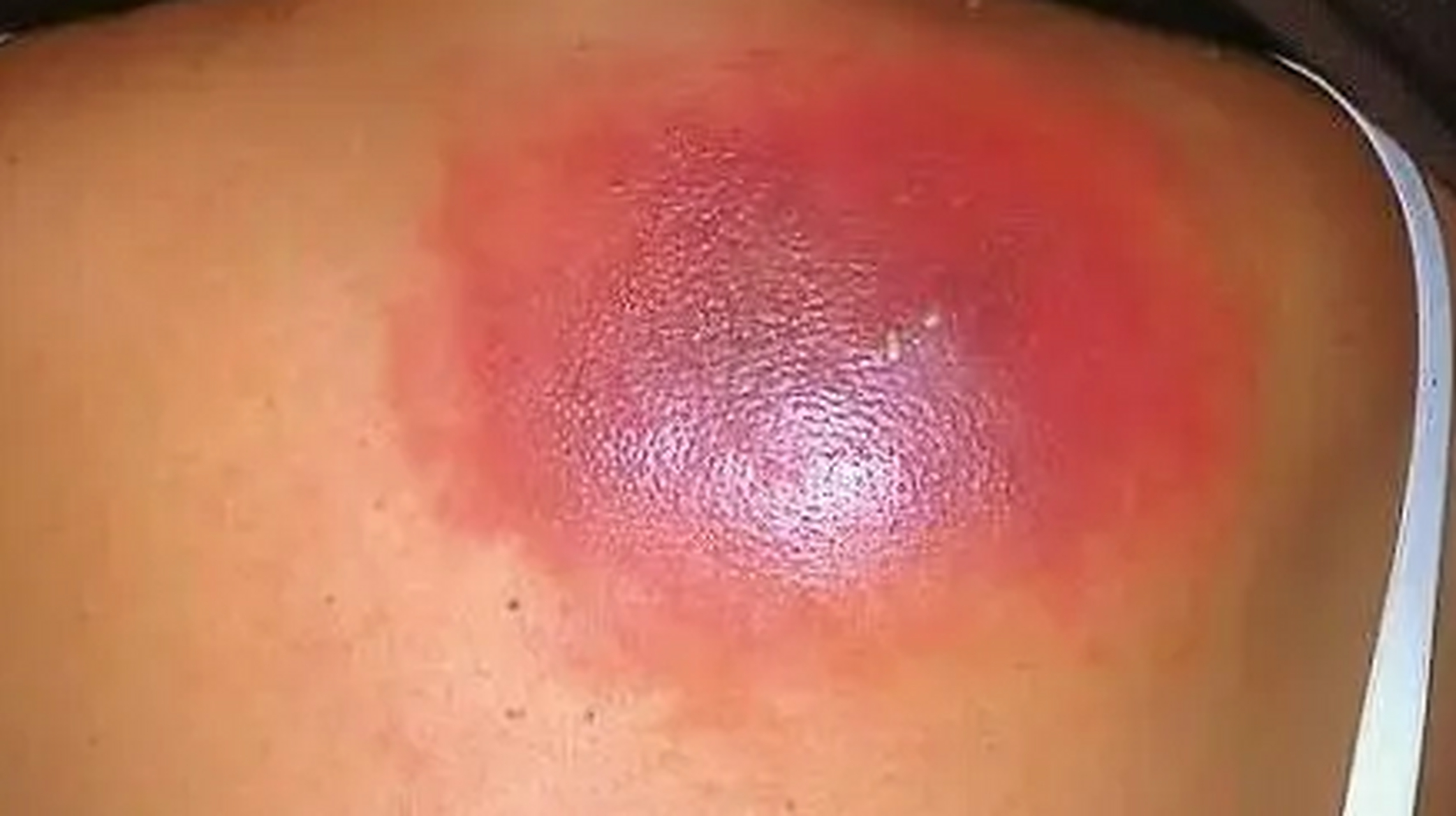 但是过了一周,我看到大疙瘩破了,还在流脓,衣服后背上都是,我害怕极了