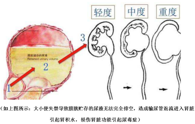 脊髓损伤截瘫引起大小便失禁有哪些手术治疗方法