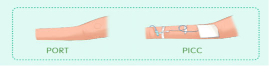 肿瘤患者的福音江油市人民医院成功开展手臂型输液港植入新技术