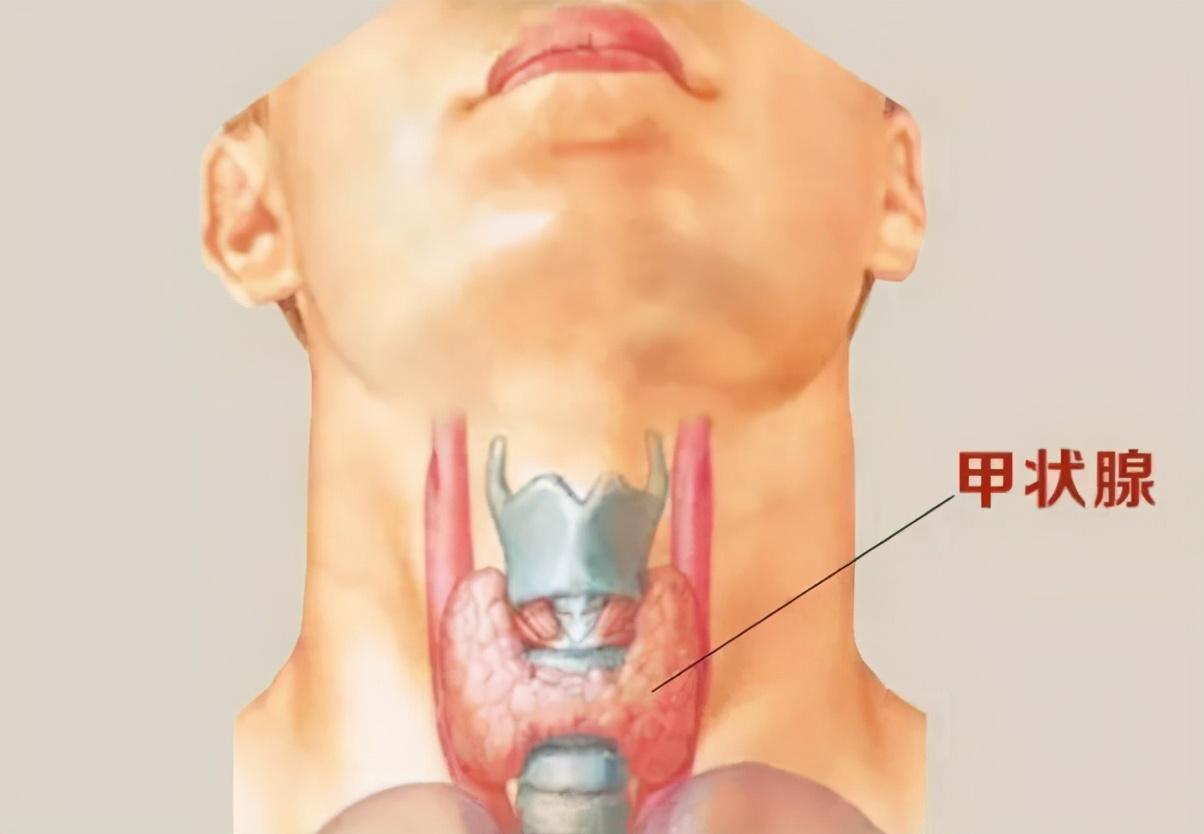 脖子变得又粗又胖,咋回事?或许是多发性甲状腺结节,莫