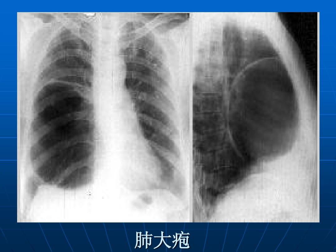 肺大疱出现胸闷气短建议及时就医,轻者对症治疗,重者需手术治疗