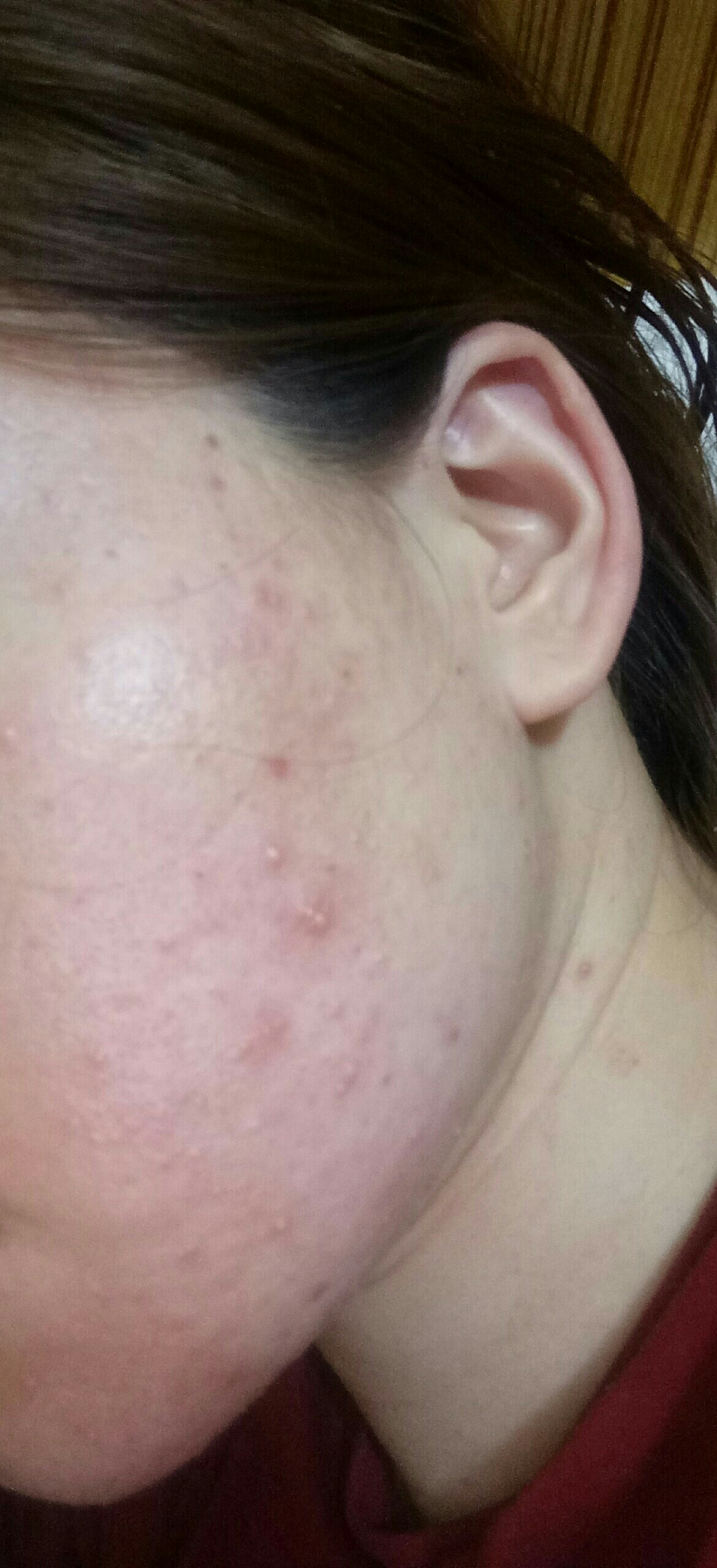 不想要痘痘肌,改善凹凸不平的肌肤表面,哪种医美适合呢?