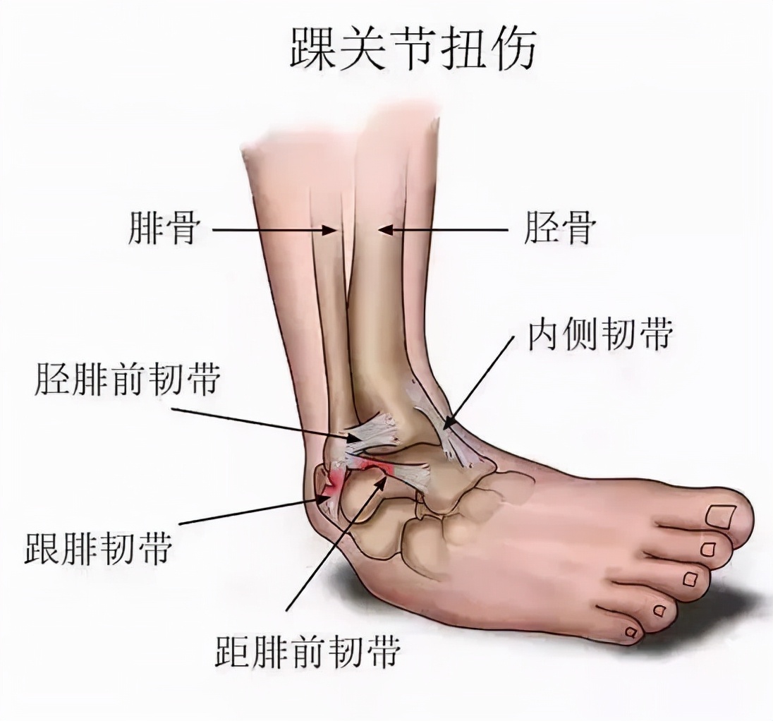 脚腕扭伤多久能好图片