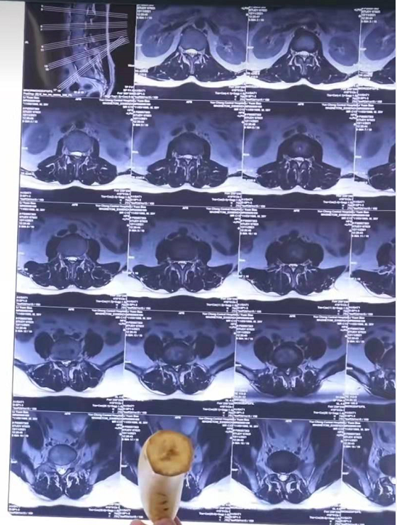 学会这个方法,离开医生也能看懂自己的腰椎核磁共振片!