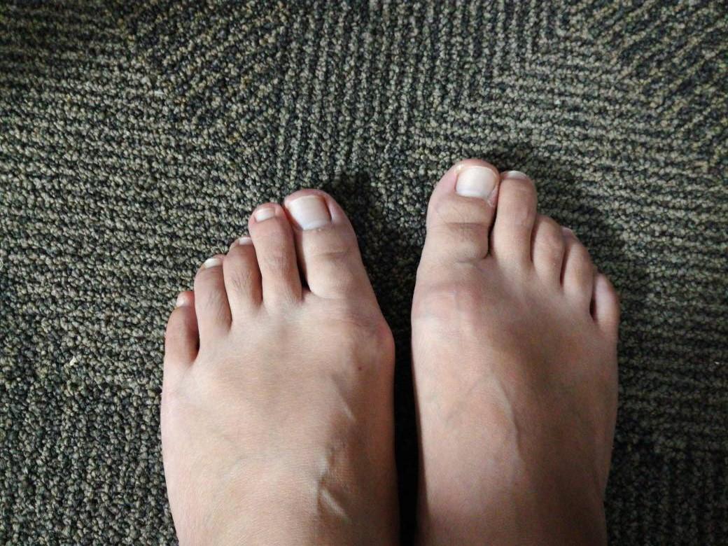 平足症,在初步检查的时候,需要注意患者负重状态下的足部形态