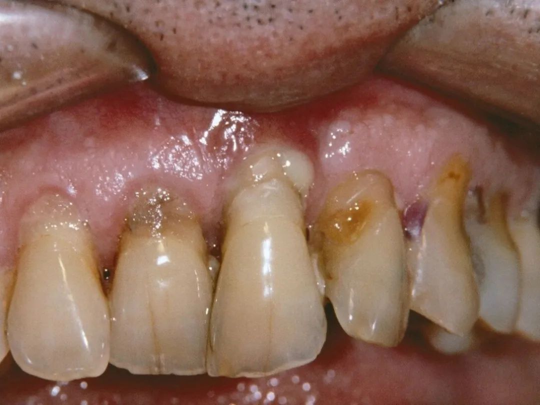 牙龈萎缩是什么?对身体有什么影响?专家:这3个病因要知道