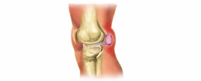 膝盖膎窝囊肿位置图图片