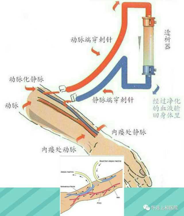 透析瘘管手术步骤图解图片