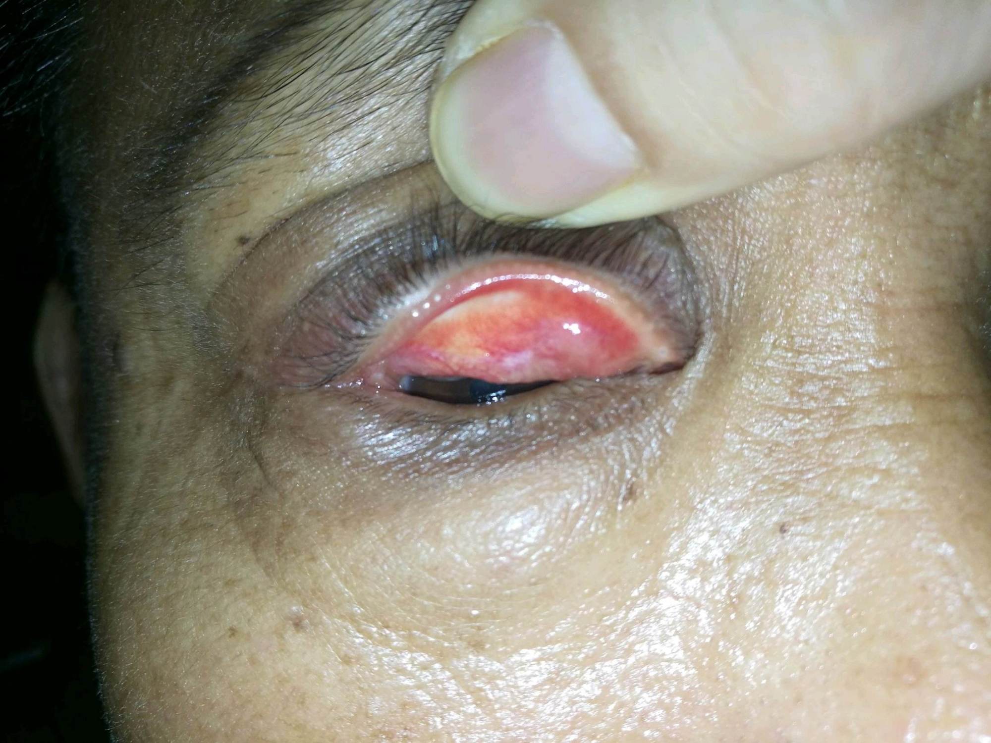 睑板腺癌是眼睑特有的恶性肿瘤,首选治疗方法是手术治疗