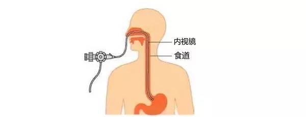 "普通胃镜"与"无痛胃镜,二者有何不同?医生告诉您答案