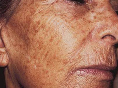 老年斑是老了才会出现的吗?为什么有些人年纪大却不长老年斑呢?