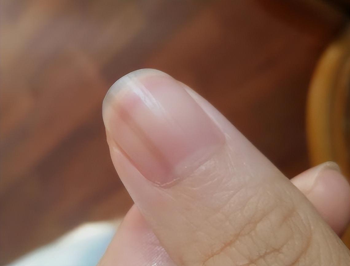 指甲上有竖纹,究竟是咋回事?是老人说的肝不好吗?
