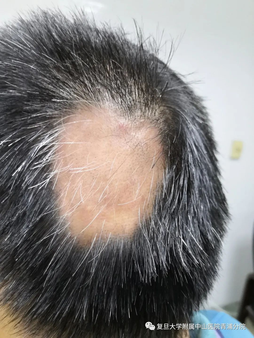 烦恼斑秃被治愈 感激致谢送锦旗