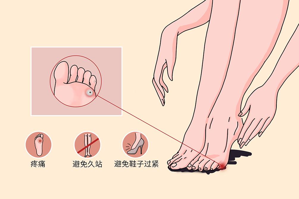 什么是鸡眼,跖疣,胼胝?有什么区别?听听医生怎么说