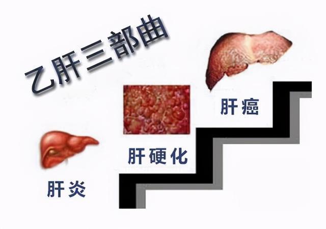 乙肝不能吃羊肉?提醒:真正不能吃的食物,已列成清單,提早收藏