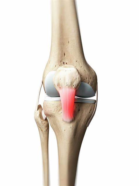 髌腱炎patellar tendinitis