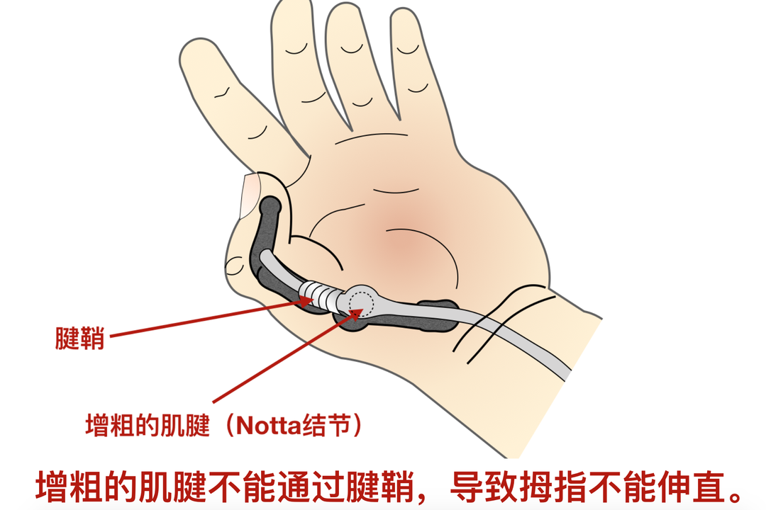 手指腱鞘炎可以一招搞定!