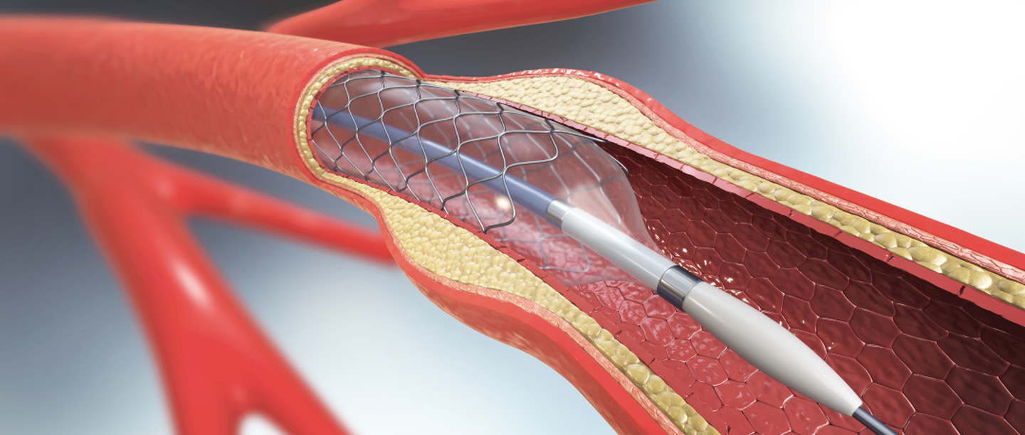 血管支架寿命图片