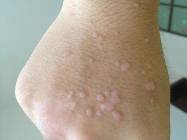 感染hpv皮肤图片