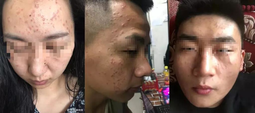 痘痘还是扁平疣?别再傻傻分不清!