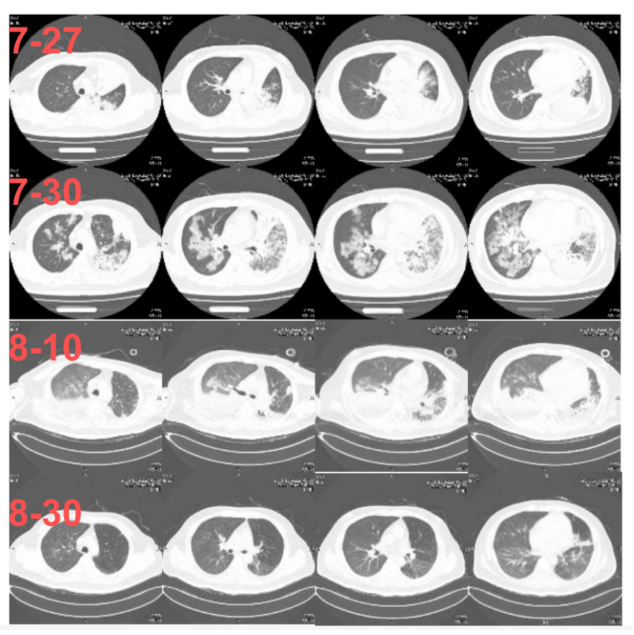 转危为安!医生巧妙诊治侵袭性肺毛霉病