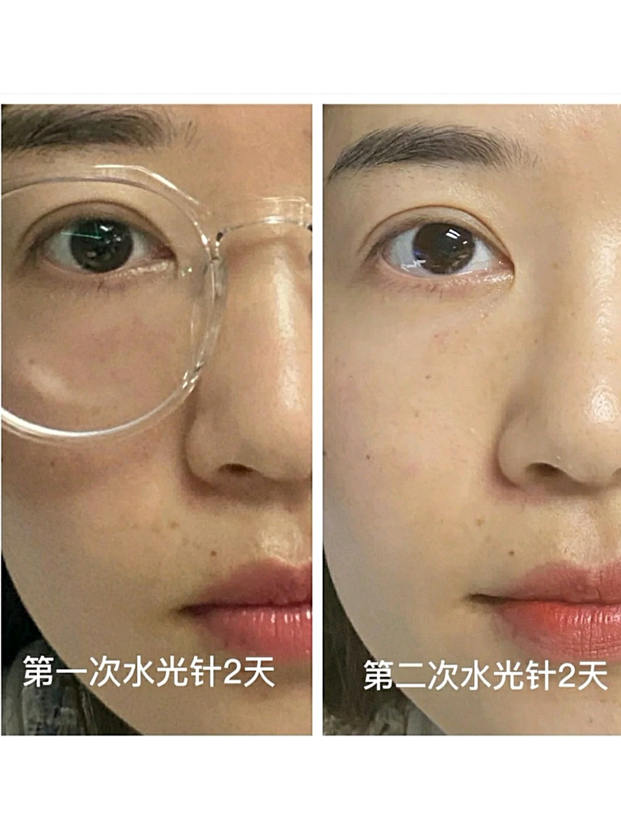 为什么要进行水光针治疗?频率如何控制?与玻尿酸有何异同?