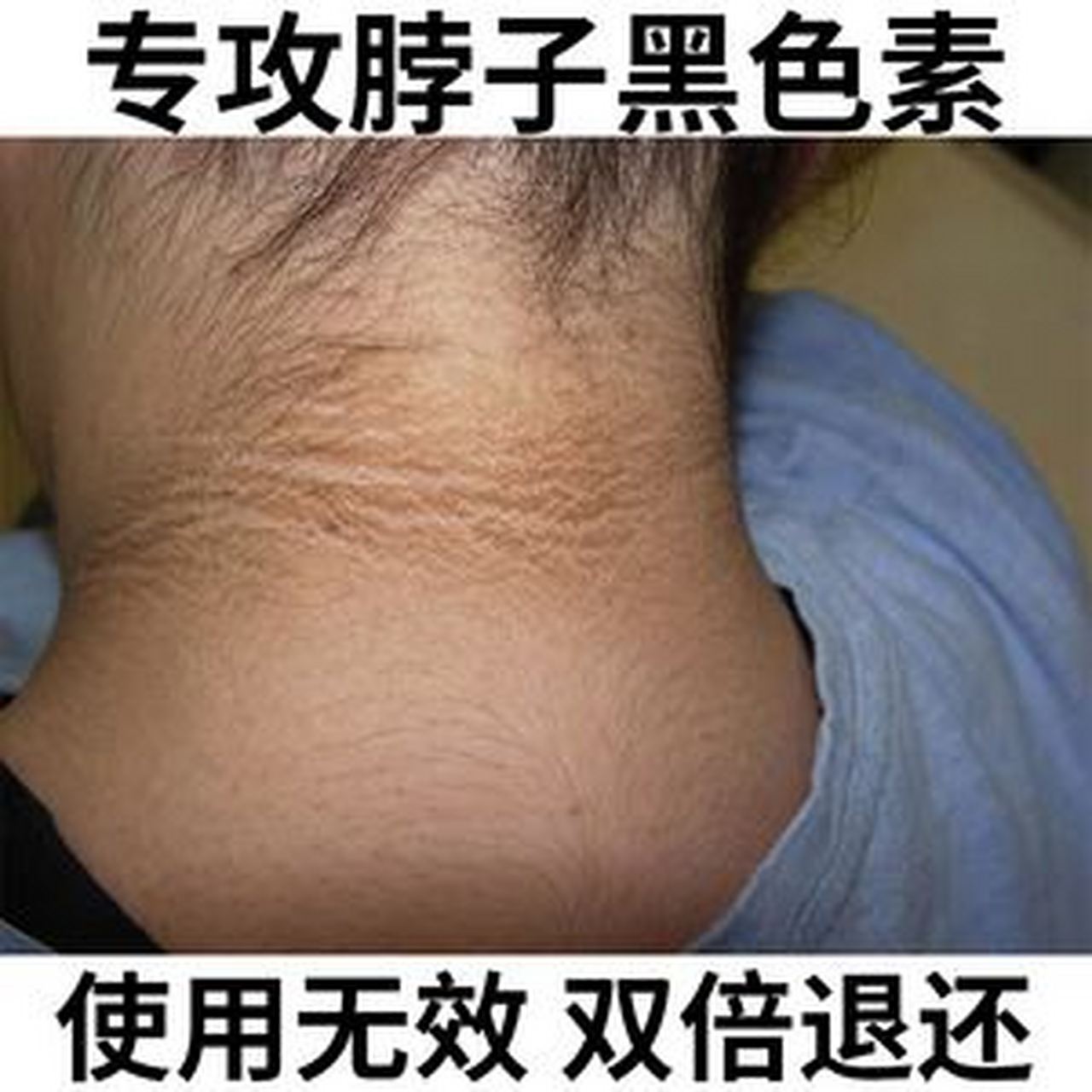 如果你正在经历脖子黑色素沉着的问题,可以尝试以下几种方法来减轻