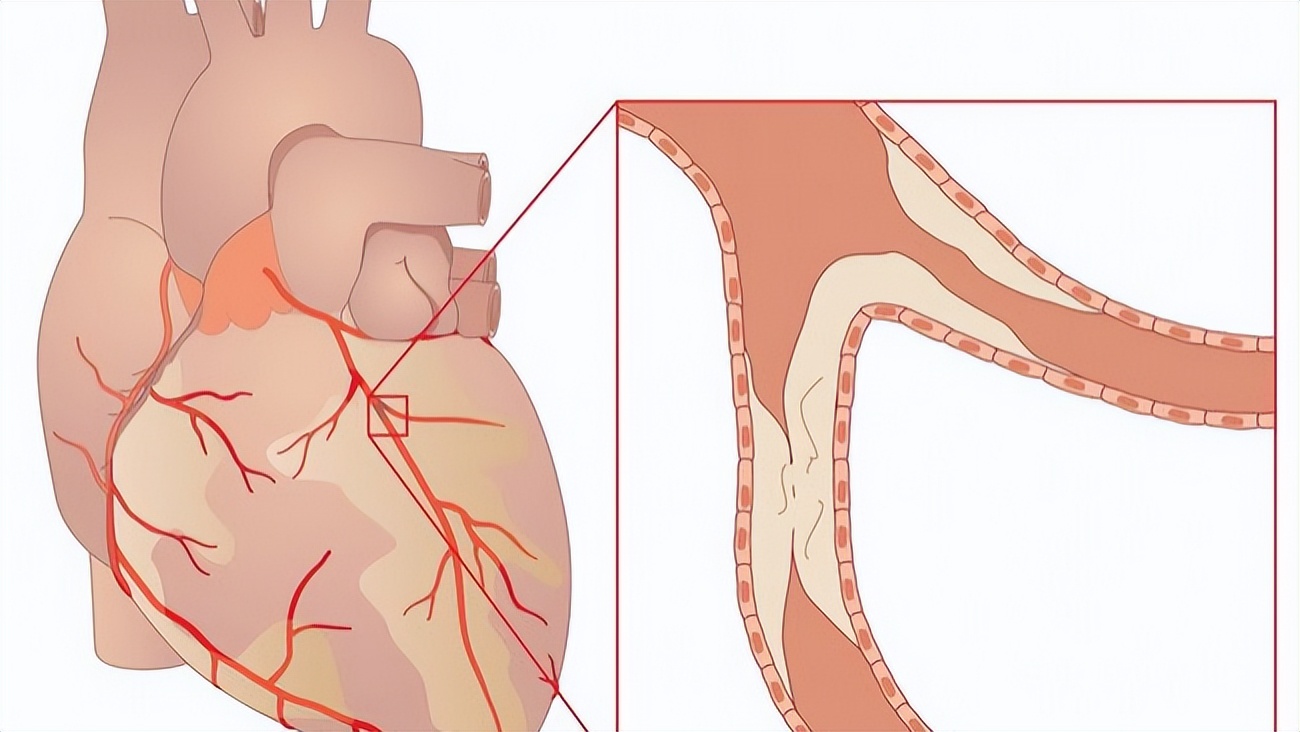 心脏右冠状动脉图图片