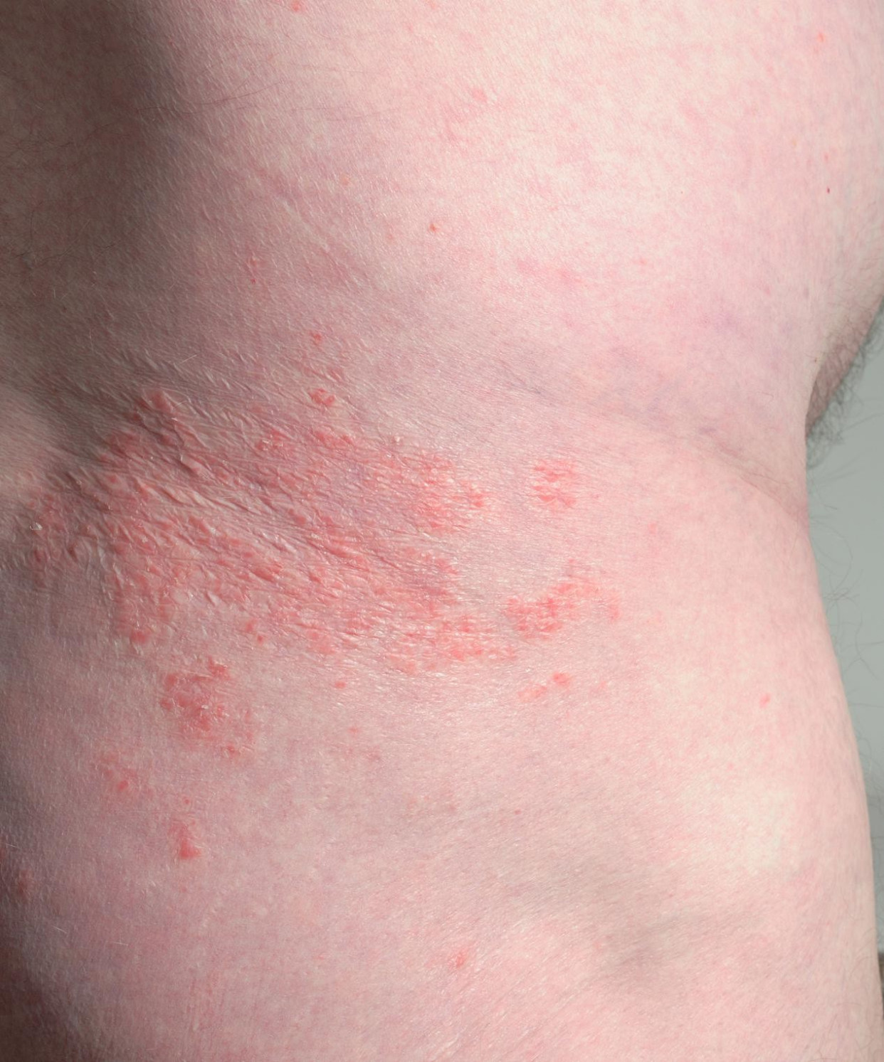 荨麻疹如何鉴别?教您几招方法,学会后就能轻松辨认