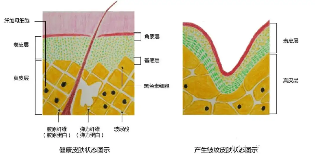 面部产生的细纹,主要是与皮肤真皮层的成纤维细胞活性降低,胶原纤维与