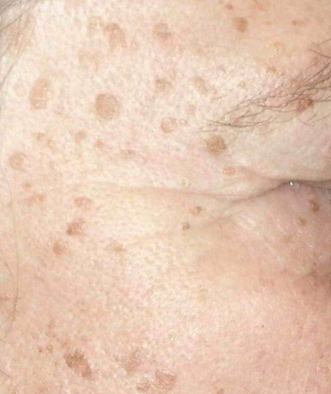 我婆婆还不到60岁,最近脸上开始出现一些色斑,我有点怀疑是老年斑,但