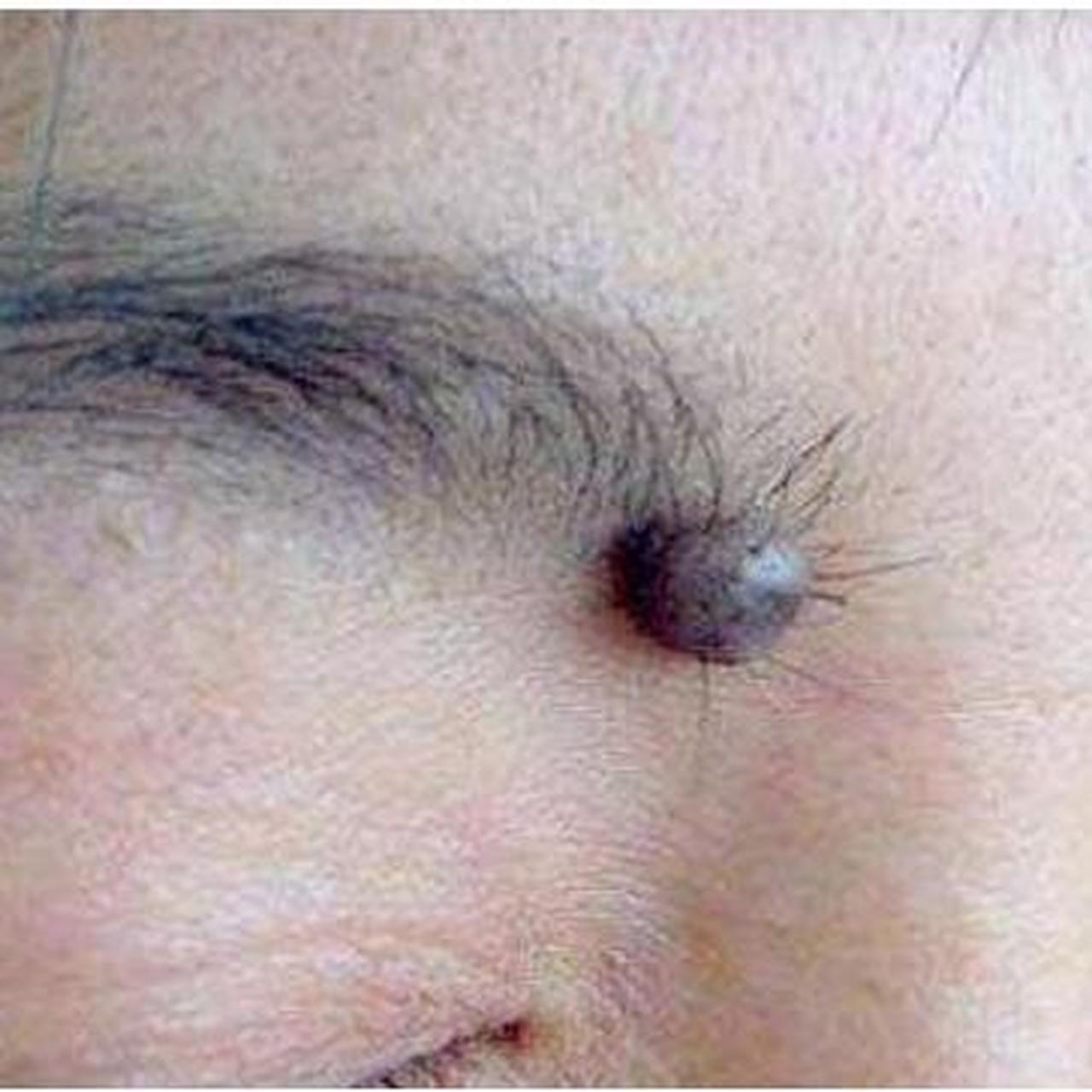 "一个月前,我眉毛上方突然发现长了一个肉痣,呈现咖啡色的,类似黄豆