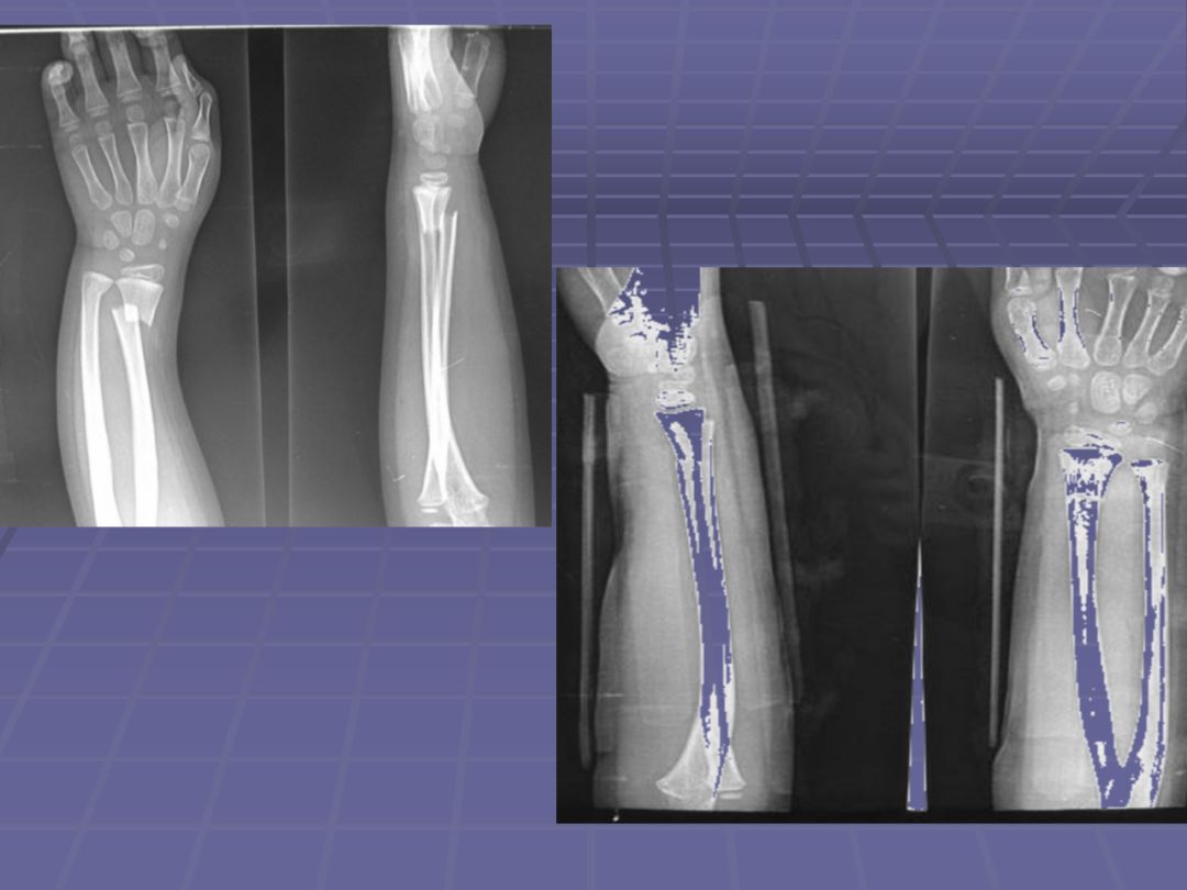 先天性桡骨缺如,一种较少见的先天性畸形,表现为前臂向桡侧弯曲