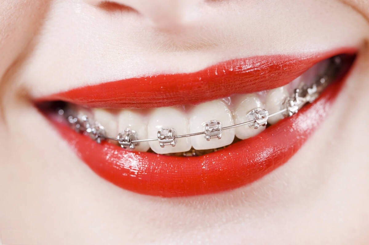 金属托槽矫正,让牙齿更加整齐,但矫治过程对容貌可能有影响
