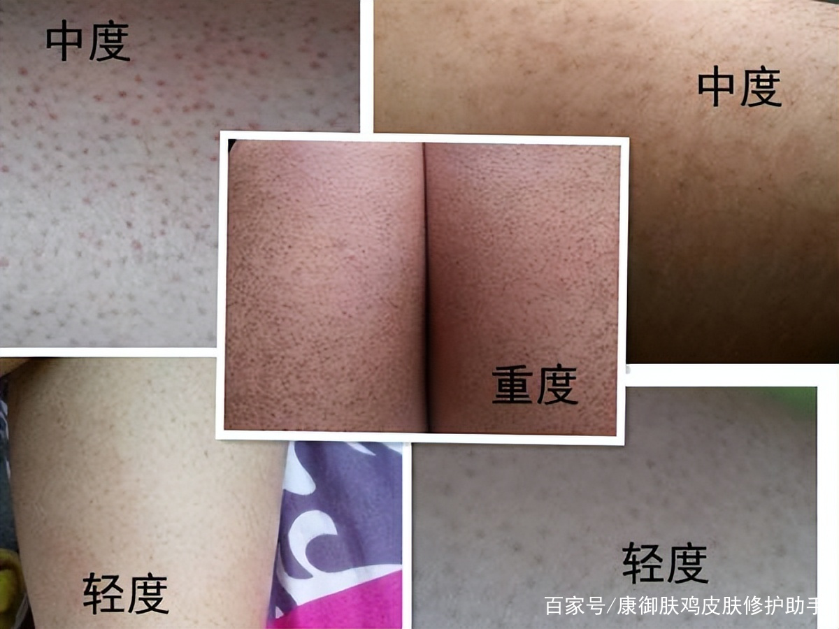 绿豆粉能去鸡皮肤吗(绿豆粉能去鸡皮肤吗图片)