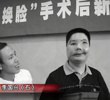 中国换脸第一人李国兴,2006年背60斤西药回家,两年后离奇去世